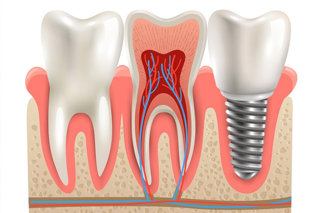 dental implants near me