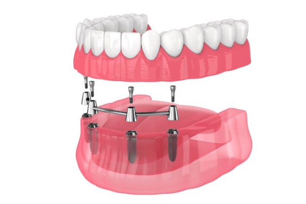 affordable dental implants