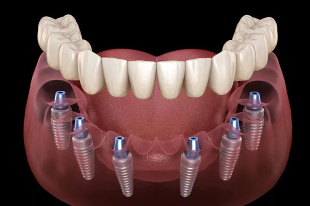 all on 4 dental implants near me