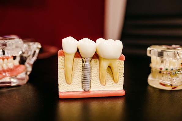 emergency dental implants