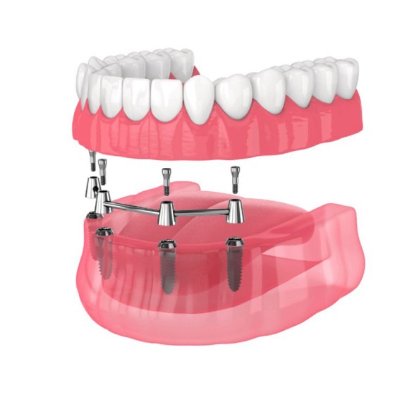 full mouth dental implants